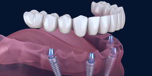 Full Mouth Dental Implants | Gilroy, CA | Replace A Full Arch